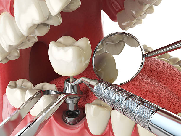 Best Chipped Tooth Repair Near Me  in Avon, CO